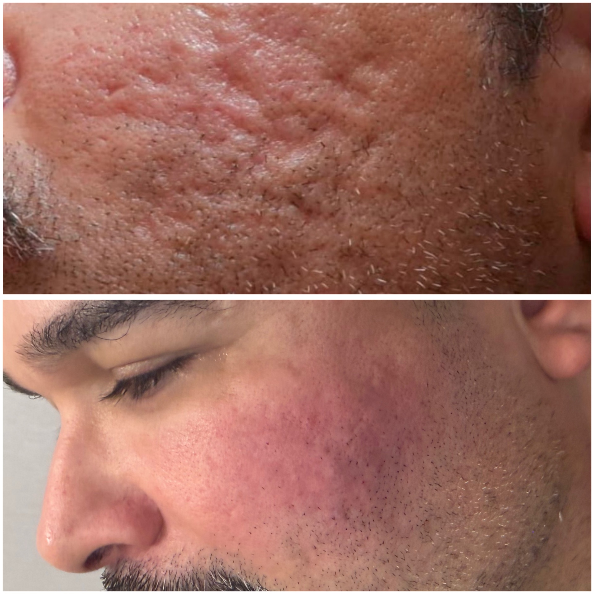 Resultado real de tratamento para cicatrizes de acne na Aura Clinic