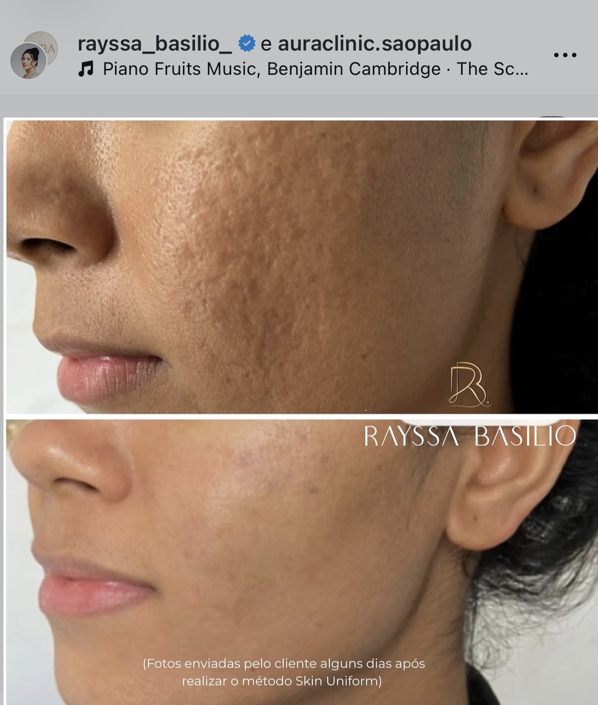 Comparativo da textura da pele antes e depois do método Skin Uniform